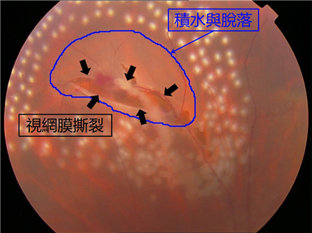 視網膜脫落對視力的影響