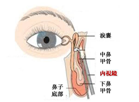 淚囊鼻腔吻合術