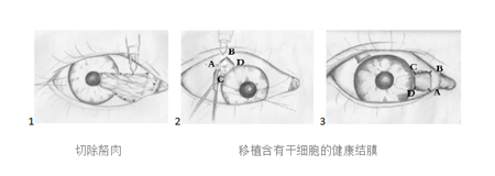 翼狀胬肉切除手術(shù)