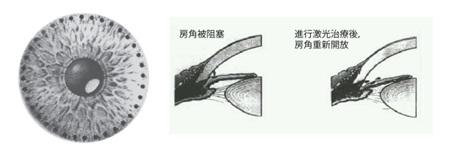 青光眼手術(shù)