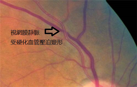 視網膜血管病變