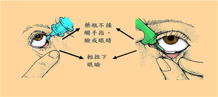 眼藥水的正確使用方法