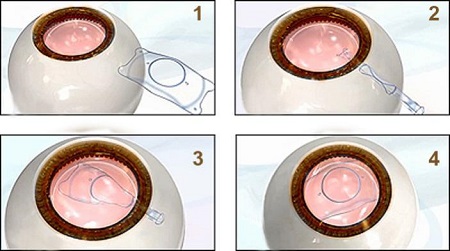 近視矯正手術(shù)，摘掉眼鏡不是夢(mèng)