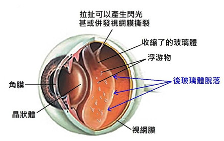 視網膜撕裂