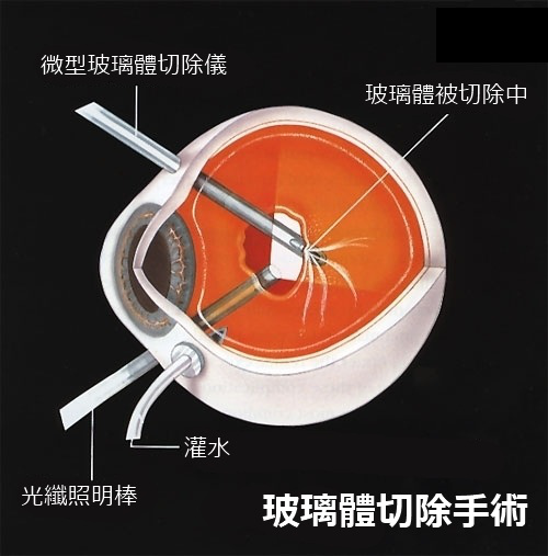 玻璃體切割手術治療視網膜脫離的優勢