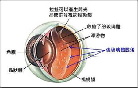 后玻璃體脫落