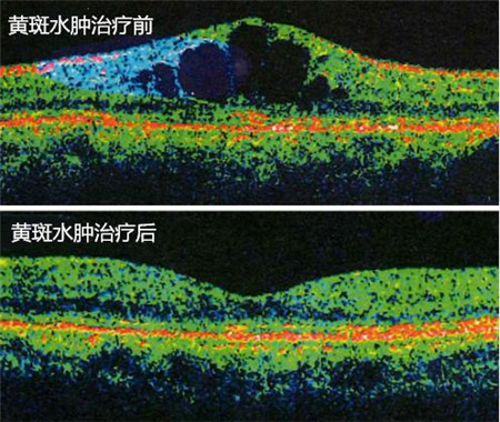 北京治療黃斑水腫