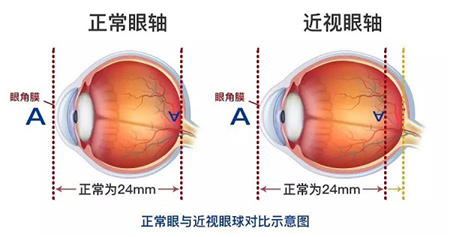 高度近視者眼軸長