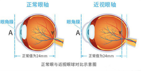 戴眼鏡會導(dǎo)致近視度數(shù)上漲嗎