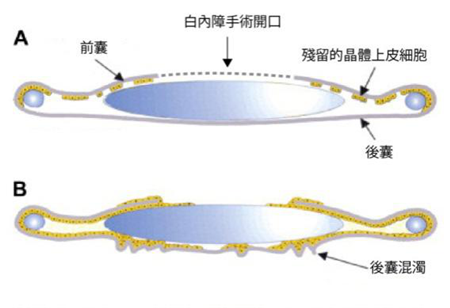 白內障術后復發怎么辦