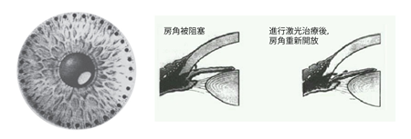 北京青光眼治療哪個醫(yī)院好
