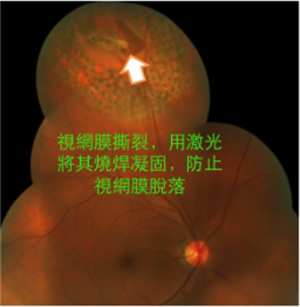 視網膜撕裂治療