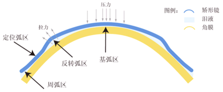 ok鏡是如何矯正視力的？