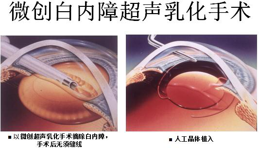 北京治療白內障多少錢