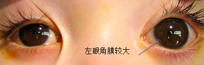 北京治療兒童青光眼哪個醫(yī)院好