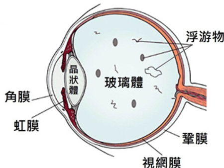 飛蚊癥是如何產生的