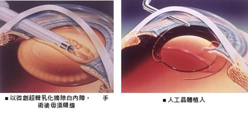 白內(nèi)障手術(shù)