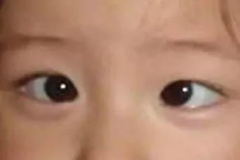 眼球震顫治療有哪些方法？